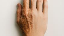 A close-up of a hand divided down the center, with one side appearing wrinkled and spotted, and the other side smooth and youthful.